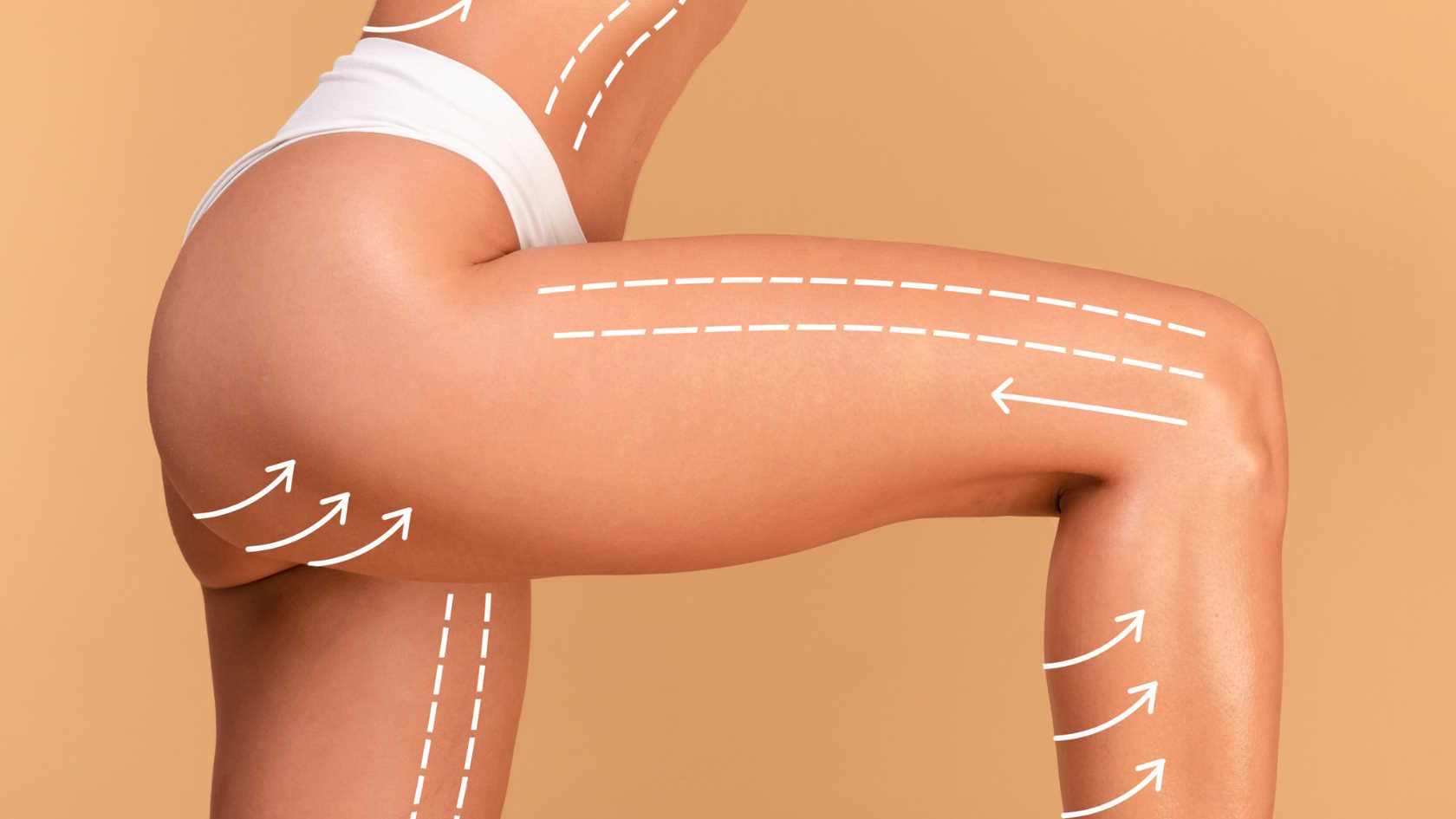 Lipoliza iniekcyjna uda - efekty