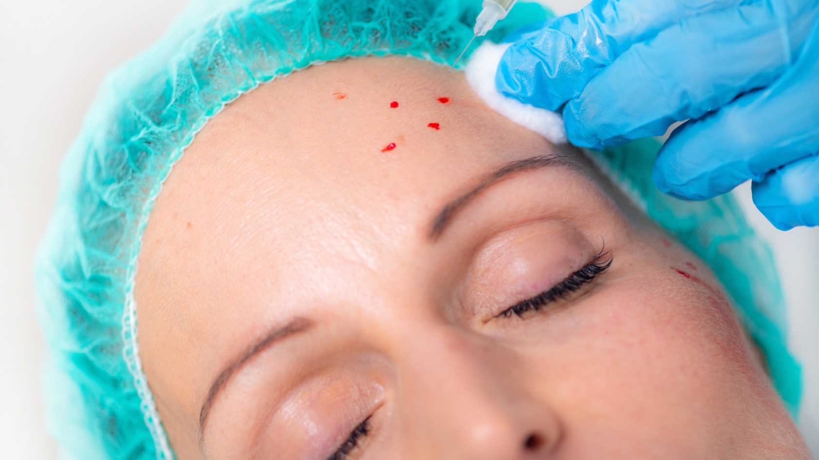 Efekty po zabiegu osoczem bogatopłytkowym