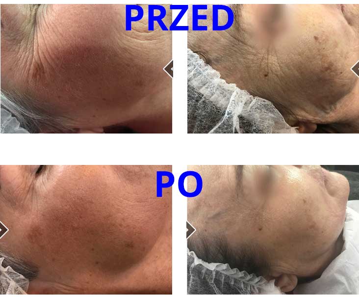 terapia estgen przed i po