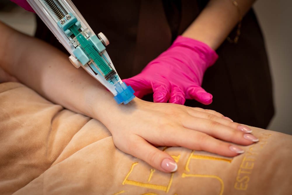 mezoterapia igłowa Laser Beauty Opole