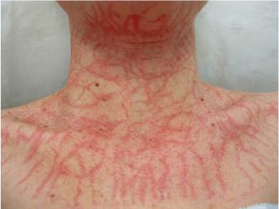 ZDJĘCIE EFEKTU CYTOPLAZMATYCZNEGO